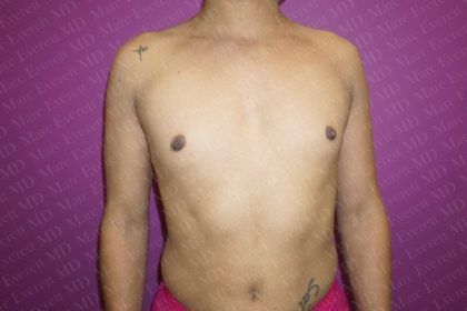 Gender Affirming Breast Augmentation Before & After Patient #2570
