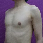 Gender Affirming Breast Augmentation Before & After Patient #2575
