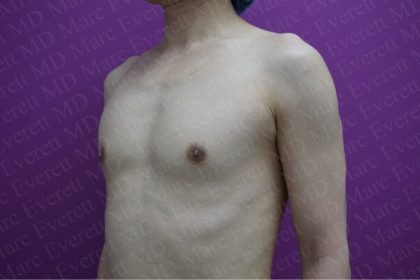 Gender Affirming Breast Augmentation Before & After Patient #2575