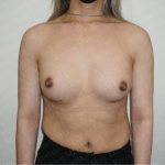 Gender Affirming Breast Augmentation Before & After Patient #2576