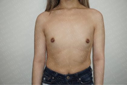 Gender Affirming Breast Augmentation Before & After Patient #2576