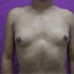 Gender Affirming Breast Augmentation Before & After Patient #2577