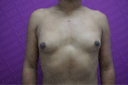 Gender Affirming Breast Augmentation Before & After Patient #2577