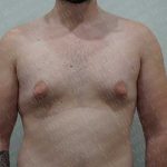 Gynecomastia Before & After Patient #2126