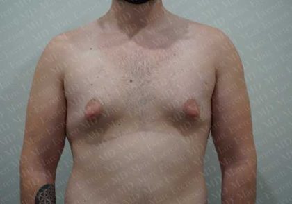 Gynecomastia Before & After Patient #2126