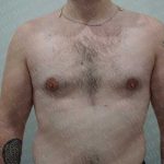 Gynecomastia Before & After Patient #2126