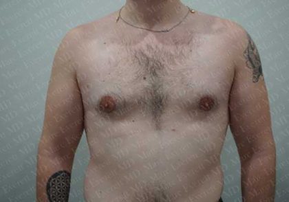 Gynecomastia Before & After Patient #2126