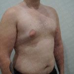 Gynecomastia Before & After Patient #2126