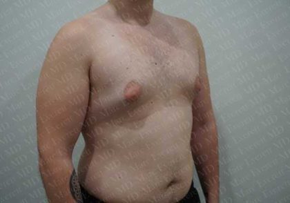 Gynecomastia Before & After Patient #2126