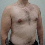 Gynecomastia Before & After Patient #2126