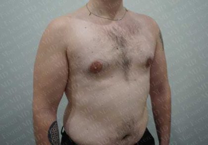 Gynecomastia Before & After Patient #2126