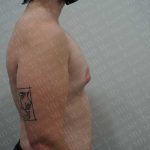 Gynecomastia Before & After Patient #2126