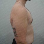 Gynecomastia Before & After Patient #2126