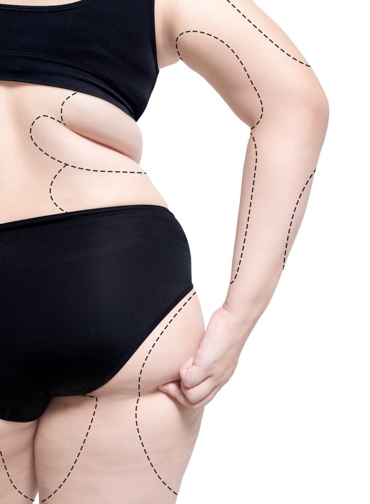 Liposuction, Marc Everett, New York, New York