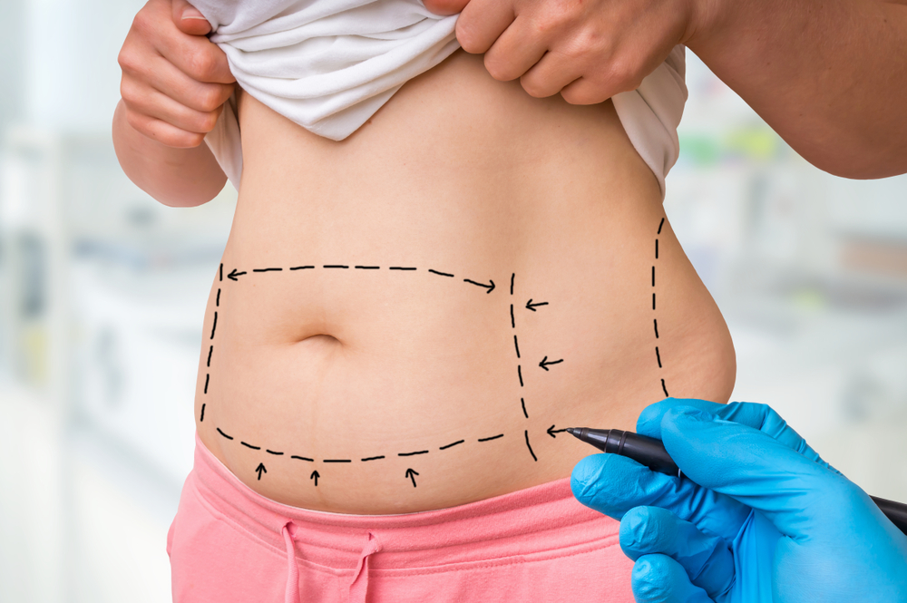 Liposuction vs. Tummy Tuck: What's the Difference?