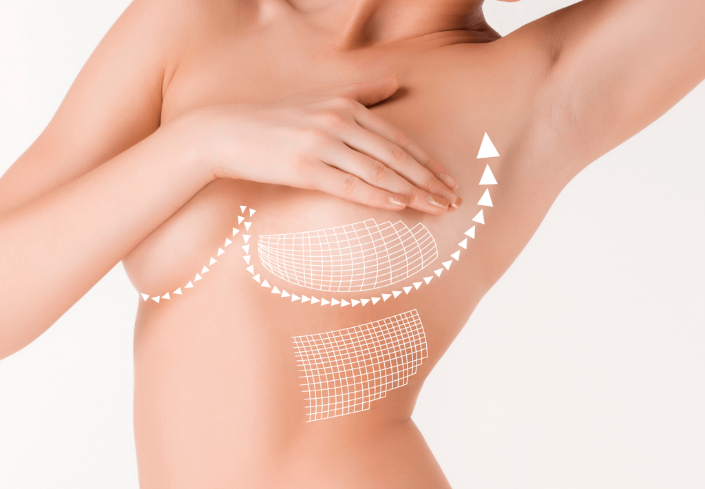 What is an Internal Bra Breast Lift and Reduction?