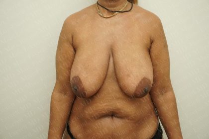Breast Reduction Before & After Patient #2220