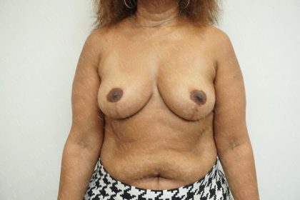 Breast Reduction Before & After Patient #2220