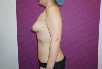Breast Augmentation Before & After Patient #2622