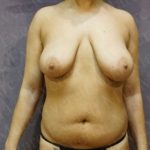 Breast Lift Before & After Patient #2947