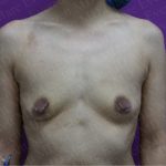 Breast Augmentation Before & After Patient #2624