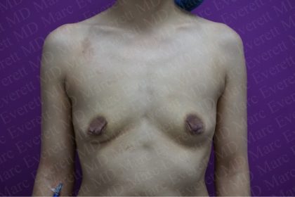 Breast Augmentation Before & After Patient #2624