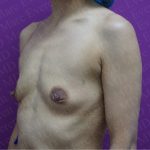 Breast Augmentation Before & After Patient #2624