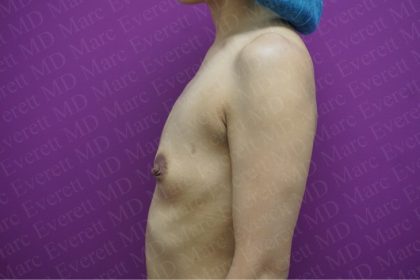 Breast Augmentation Before & After Patient #2624