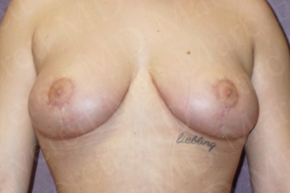 Breast Lift Before & After Patient #2947