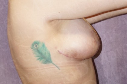 Breast Lift Before & After Patient #2947