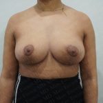 Breast Lift Before & After Patient #2803