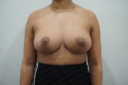 Breast Lift Before & After Patient #2803