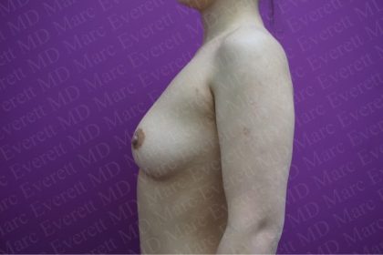 Breast Augmentation Before & After Patient #2676