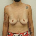 Breast Lift Before & After Patient #2802