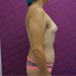 Breast Augmentation Before & After Patient #2644