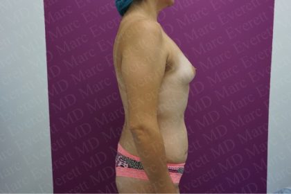 Breast Augmentation Before & After Patient #2644