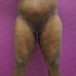Thigh Lift Before & After Patient #2738