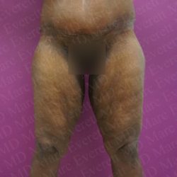 Thigh Lift Before & After Patient #2738