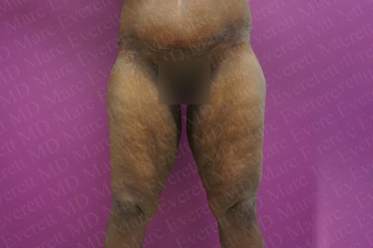 Thigh Lift Before & After Patient #2738