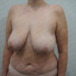 Breast Lift Before & After Patient #2833