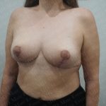 Breast Lift Before & After Patient #2833