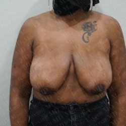 Breast Lift Before & After Patient #2774