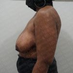 Breast Lift Before & After Patient #2774