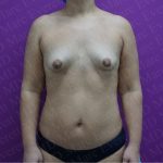 Breast Augmentation Before & After Patient #2604