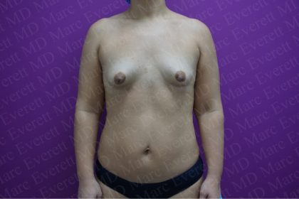 Breast Augmentation Before & After Patient #2604