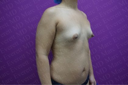 Breast Augmentation Before & After Patient #2604