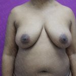 Breast Lift Before & After Patient #2914