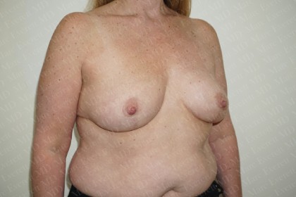 Breast Lift Before & After Patient #2948