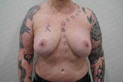 Breast Lift Before & After Patient #2879