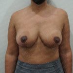 Breast Lift Before & After Patient #2805